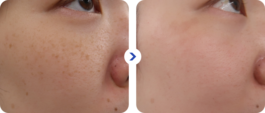 治療前と治療1ヶ月後